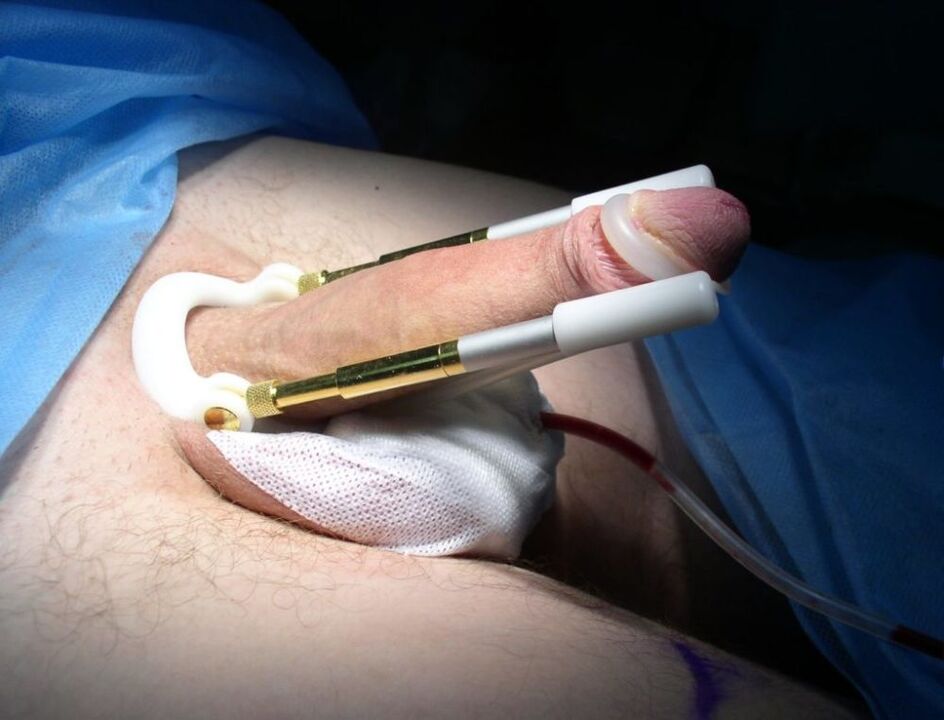 Enlargement after penis enlargement surgery