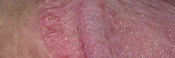 Dry skin and ulcers on top of the penis after applying baking soda